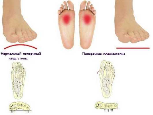 Тест на плоскостопие
