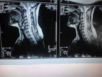 Шейный спондилез