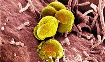 Фото Спондилит позвоночника