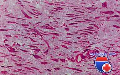 криминальный аборт