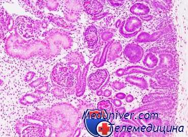 внутриутробная асфиксия