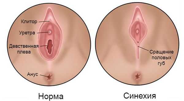 Сращение малых половых губ