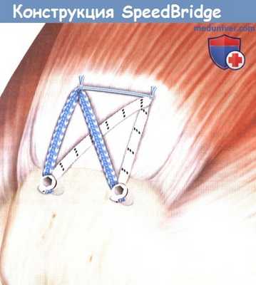 Конструкция SpeedBridge