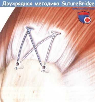 Двухрядная реконструкция вращательной манжеты плечевого сустава (методика SutureBridge)