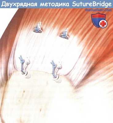 Двухрядная реконструкция вращательной манжеты плечевого сустава (методика SutureBridge)