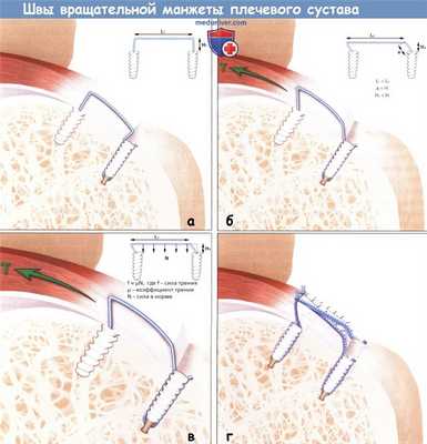 Швы вращательной манжеты плечевого сустава