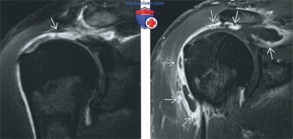 Сравнение МРТ с КТ-артрографией и МРТ-артрографией