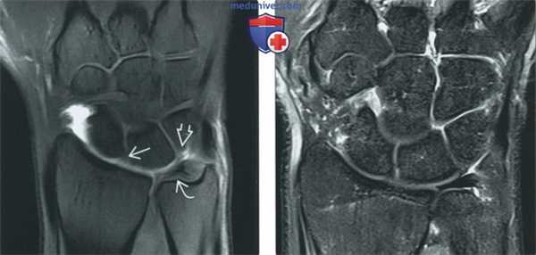 Сравнение МРТ с КТ-артрографией и МРТ-артрографией