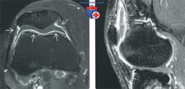 Сравнение МРТ с КТ-артрографией и МРТ-артрографией