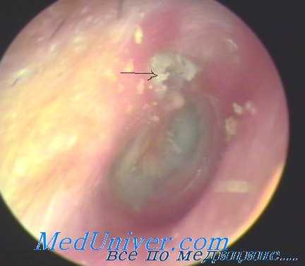 туберкулез среднего уха