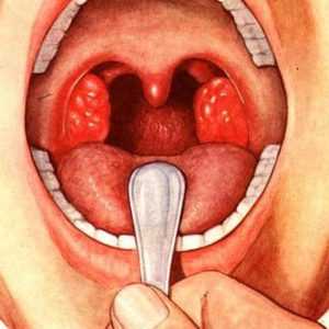 Патологии носоглоточной миндалины