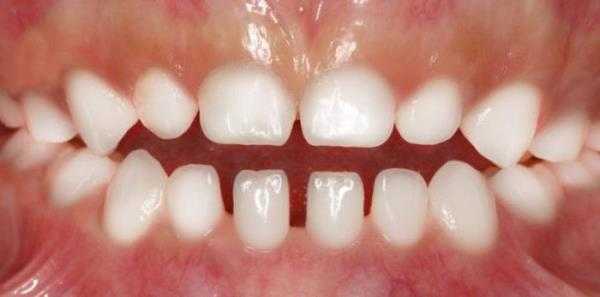 Что такое парность элементов молочного прикуса