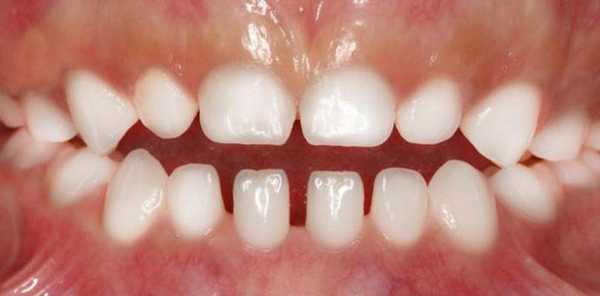 прикус у ребенка