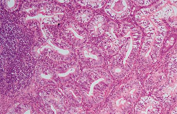 Рисунок 4. Высокодифференцированная ааденокарцинома восходящего отдела ободочной кишки. Окраска гематоксилином и эозином, Х100.