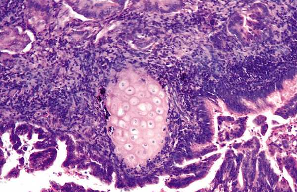 Рисунок 5. Метастаз рака толстой кишки в легкое. Окраска гематоксилином и эозином, Х100.