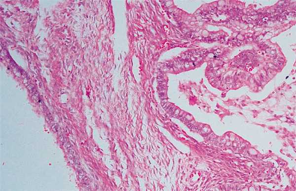 Рисунок 2. Метастаз рака желудка в яичнике. Окраска гематоксилином и эозином, х100.