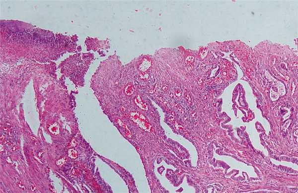 Рисунок 1. Изъязвленная умереннодифференцированная аденокарцинома желудка. Окраска гематоксилином и эозином, х40.