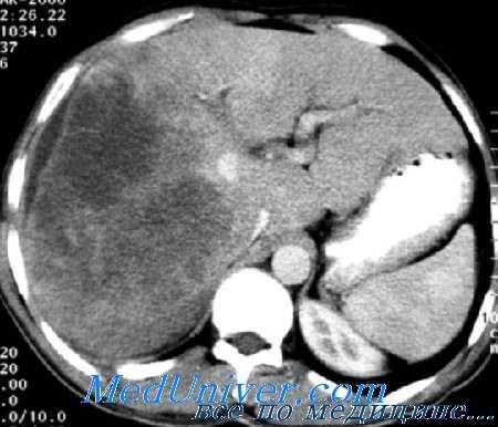 гепатоцеллюлярный рак