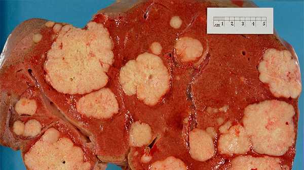 Удаленная печень со множественными злокачественными очагами