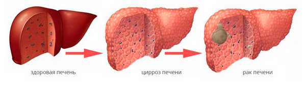 Развитие гепатоцеллюлярной карциномы на фоне цирроза печени