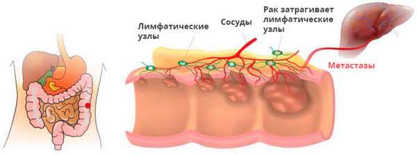 Развитие рака толстой кишки