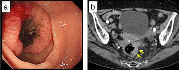 Диагностика рака прямой кишки