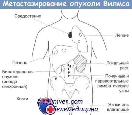 Метастазирование опухоли Вилмса