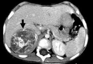 Эстезионейробластома