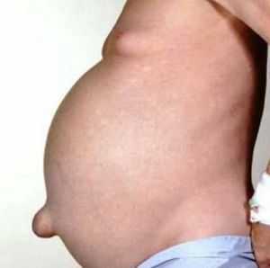 Нейробластома