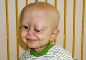 Рис. 1. Локализация нейробластомы