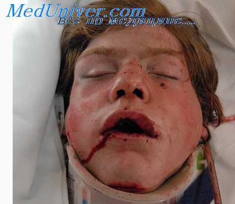 внутриротовые аппараты