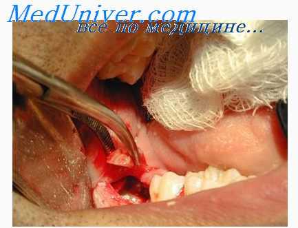 шины при переломе челюсти