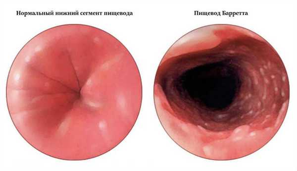 Пищевод Барретта