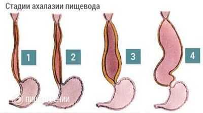 Ахалазия пищевода