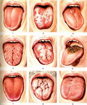 Виды глоссита