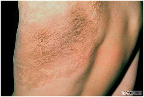 Глубокие пигментации - меланоз Беккера