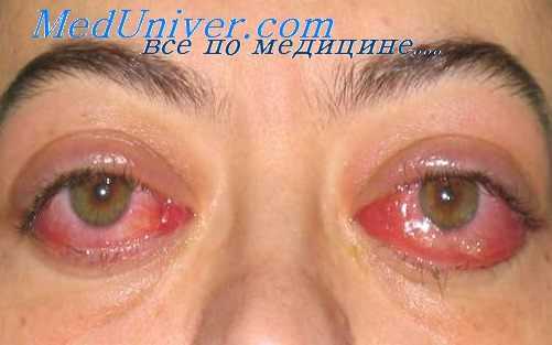 тиреотоксикоз