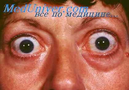 тиреотоксикоз