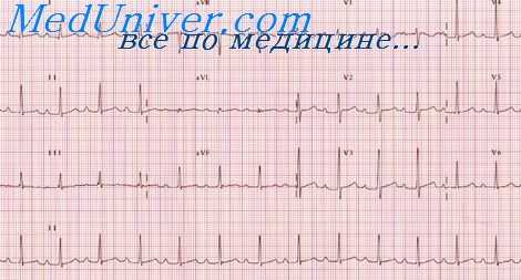экг при тиреотоксикозе