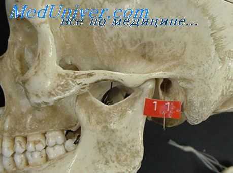 стеноз наружного слухового прохода