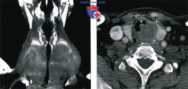 Рентгенограмма, КТ при стенозе подскладочного пространства гортани и трахеи