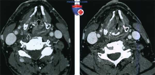 КТ, МРТ при постлучевом синдроме гортани