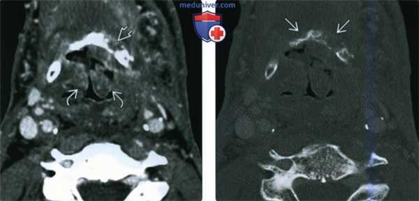 КТ, МРТ при постлучевом синдроме гортани