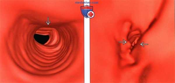 Рентгенограмма, КТ при стенозе подскладочного пространства гортани и трахеи