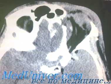 взрывные переломы глазницы