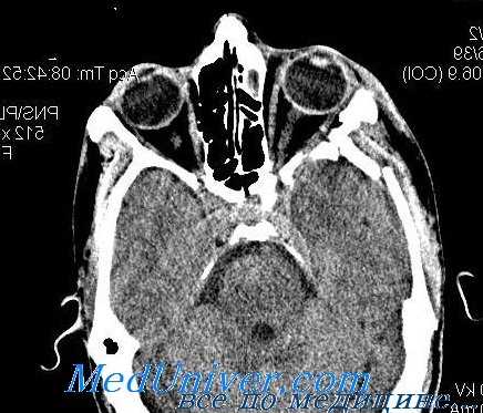 взрывные переломы глазницы