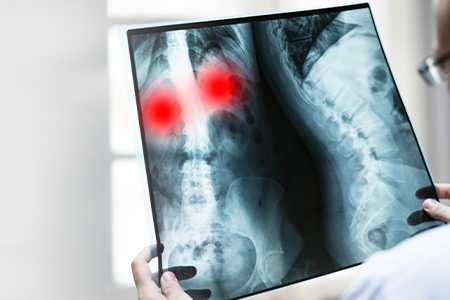 Туберкулез - Клиника ЛОРДМЕД