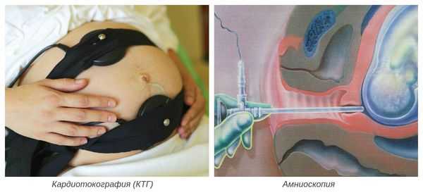 Кардиотокография и амниоскопия