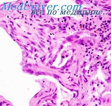 инородные тела альвеол