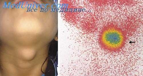 причины тиреотоксикоза